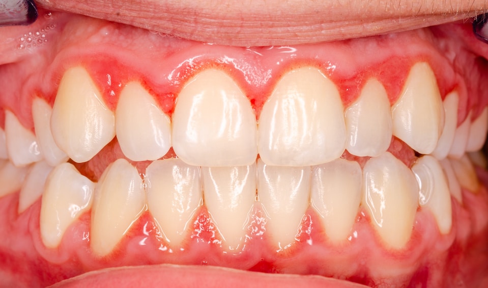 Gingivitis vs Healthy Gums