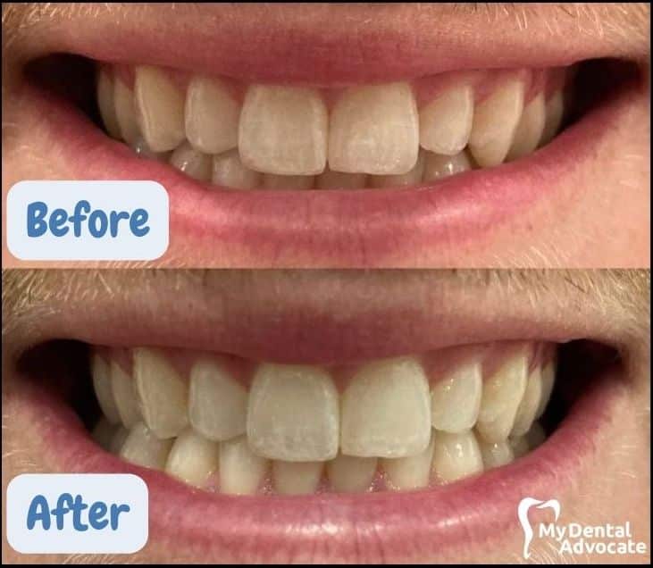 Burst Teeth Whitening Trays (Before/After) | My Dental Advocate