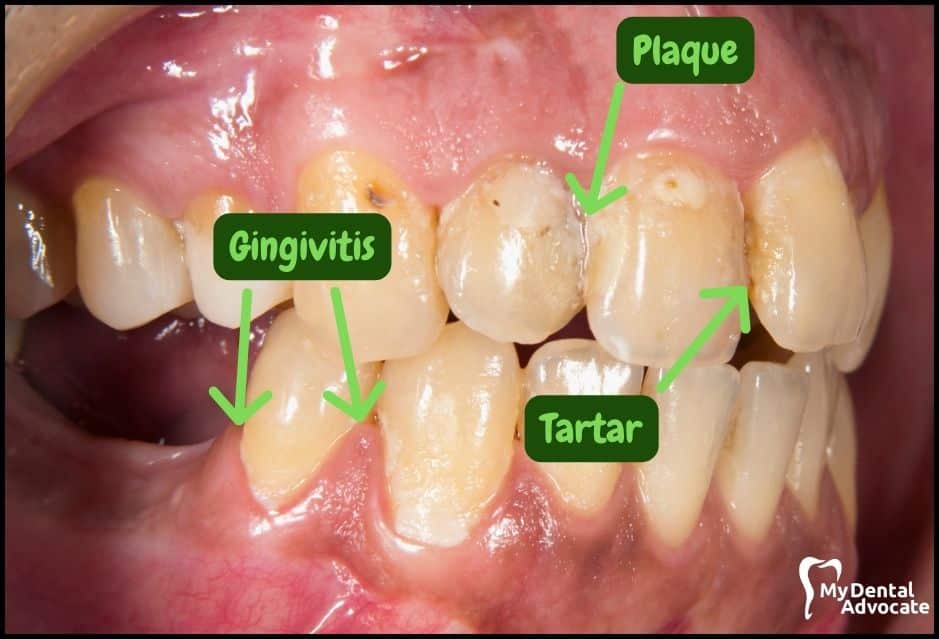 Gum Disease Pictures | My Dental Advocate