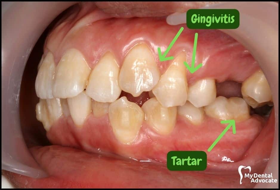 Gum Disease Pictures | My Dental Advocate