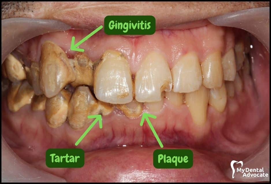 Gum Disease Pictures | My Dental Advocate