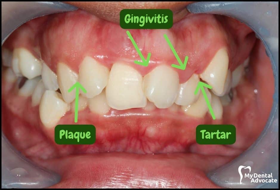 Gum Disease Pictures | My Dental Advocate