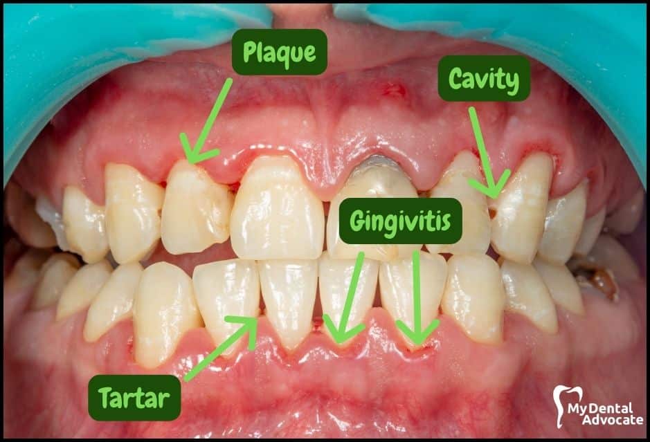 Gum Disease Pictures | My Dental Advocate