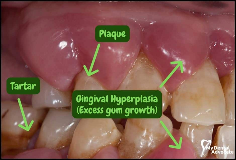 Gum Disease Pictures | My Dental Advocate