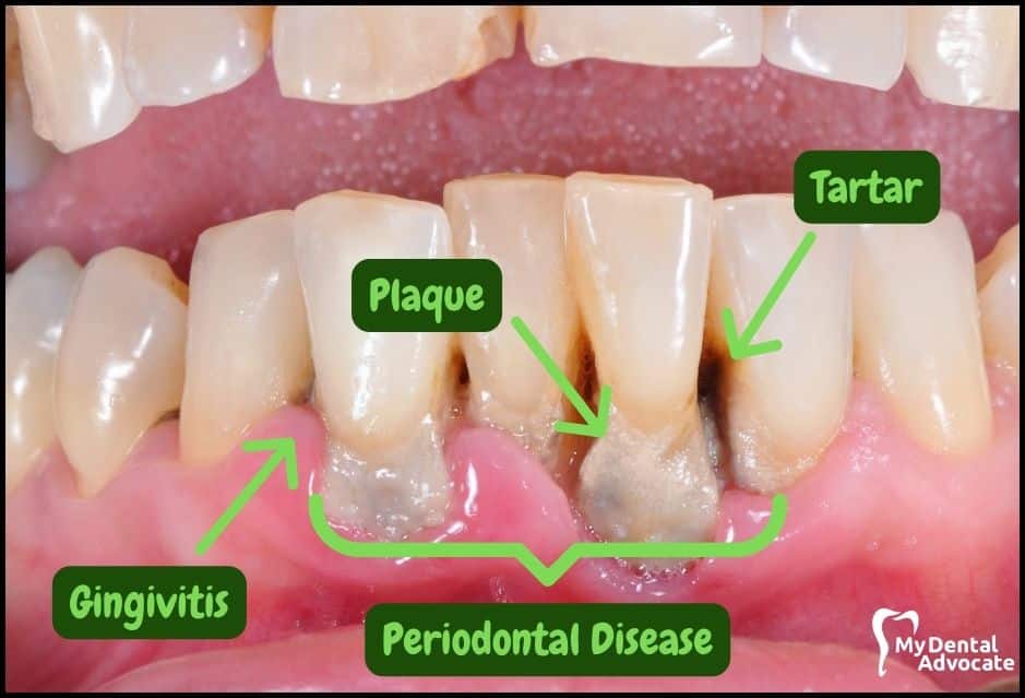 What Is Dental Plaque - Bacterial Plaque, Tartar, Gingivitis, Gum Disease