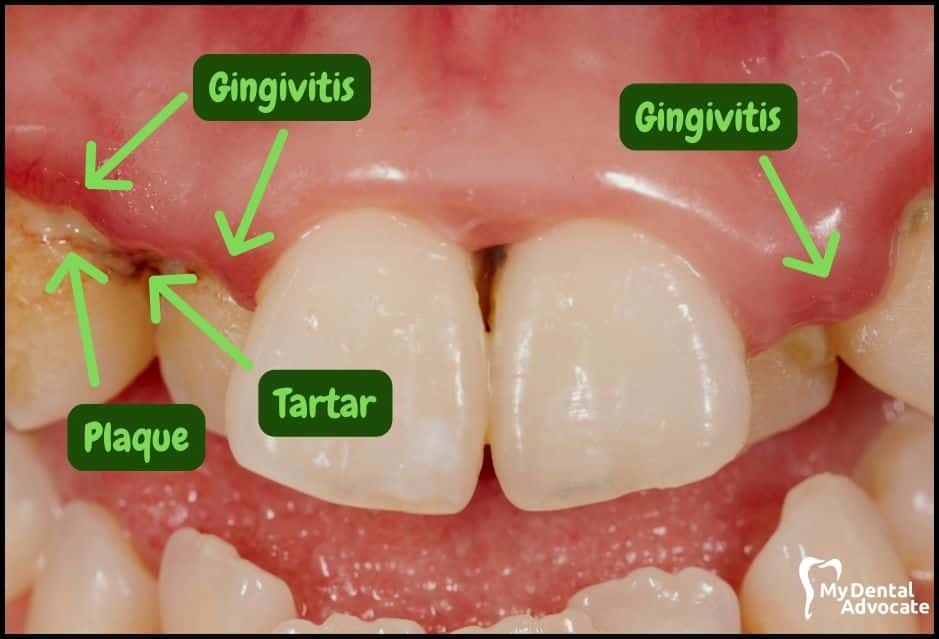 Gum Disease Pictures | My Dental Advocate