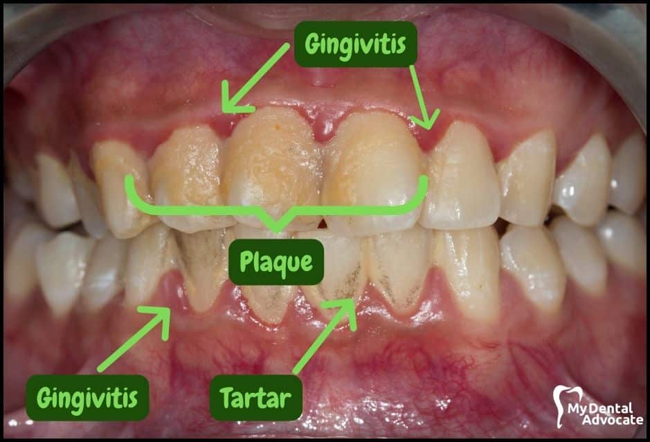 Gum Disease Pictures | My Dental Advocate