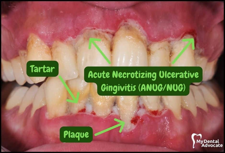 necrotizing ulcerative gingivitis vs necrotizing ulcerative periodontitis