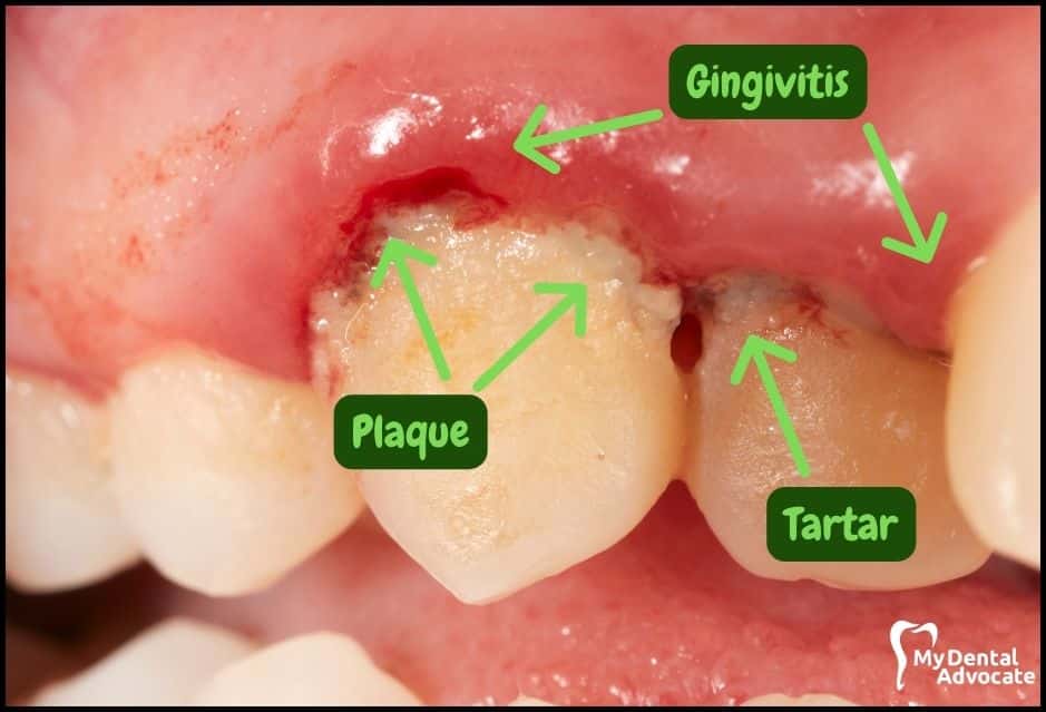 Gum Disease Pictures | My Dental Advocate