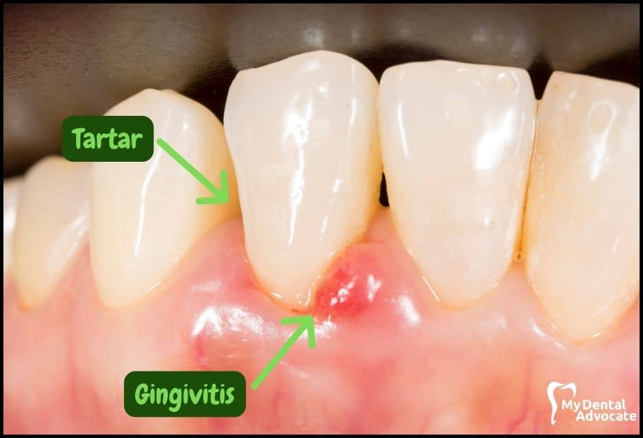 Gum Disease Pictures | My Dental Advocate