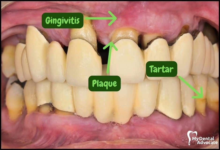 Gum Disease Pictures | My Dental Advocate