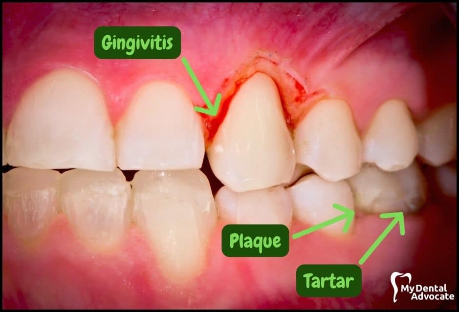 Gum Disease Pictures | My Dental Advocate