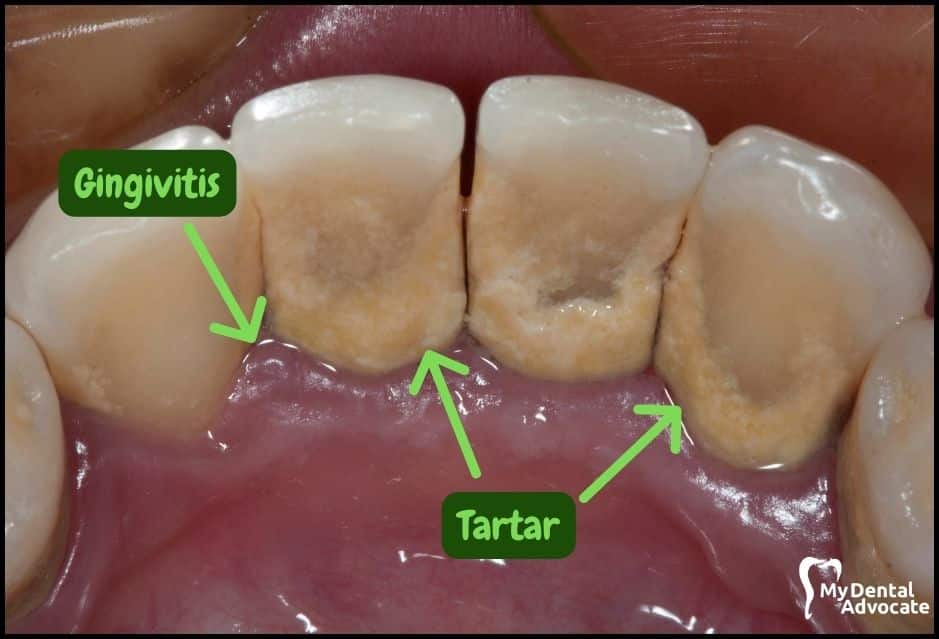 Gum Disease Pictures | My Dental Advocate