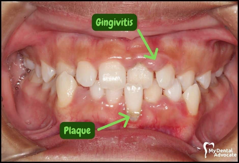 Gum Disease Pictures | My Dental Advocate