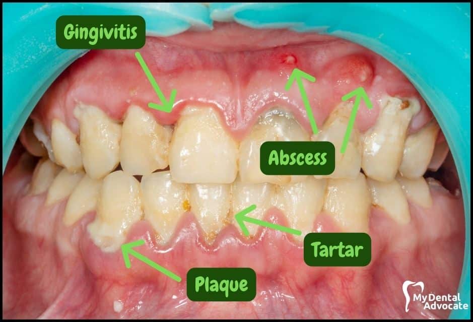 Gum Disease Pictures | My Dental Advocate