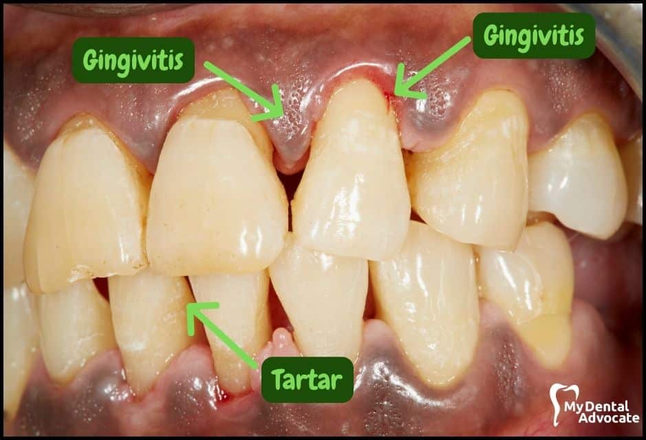 Gum Disease Pictures | My Dental Advocate