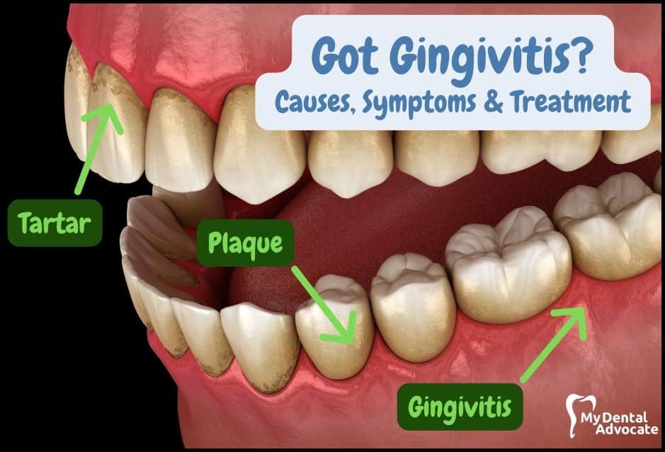 Got Gingivitis? | My Dental Advocate