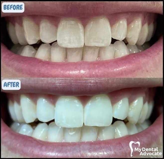 SNOW Teeth Whitening Before & After | My Dental Advocate