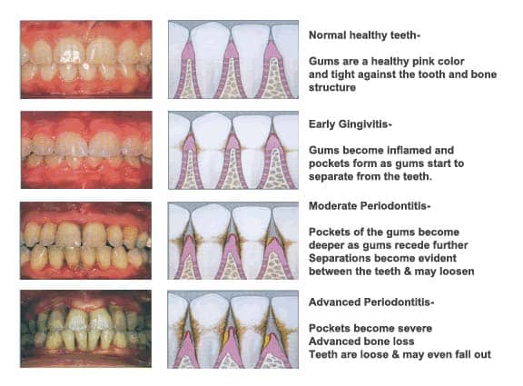 IHealth gums vs Gingivitis | My Dental Advocate
