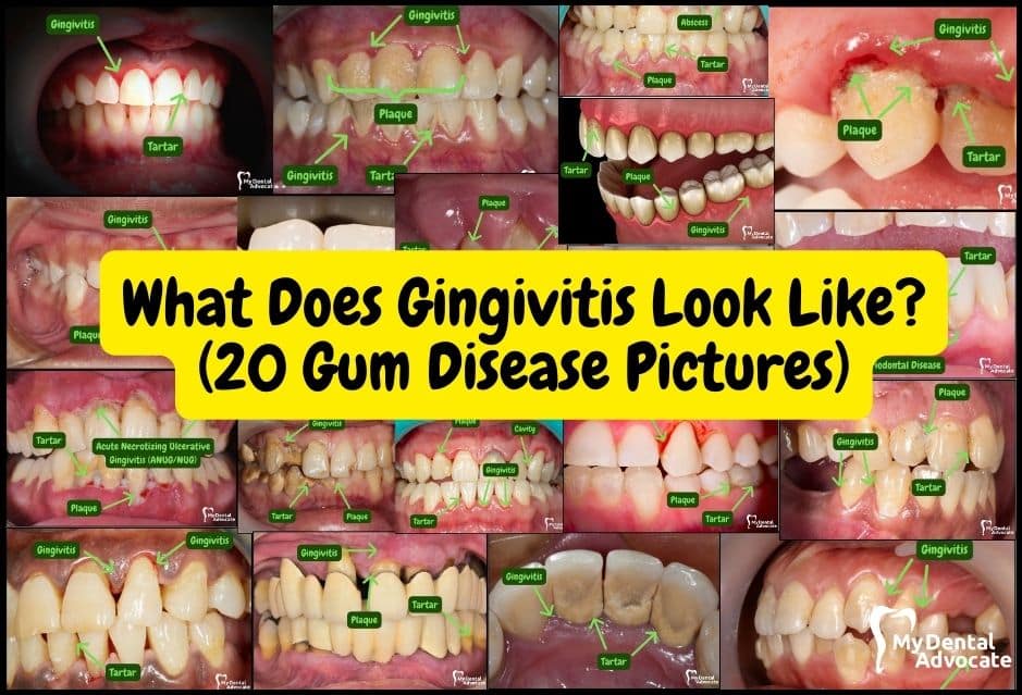 Gum Disease Pictures | My Dental Advocate