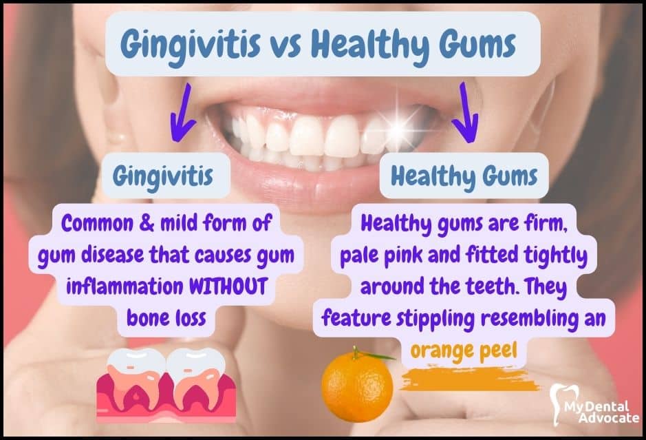 Gingivitis vs Healthy Gums (What’s the Difference?) | MDA