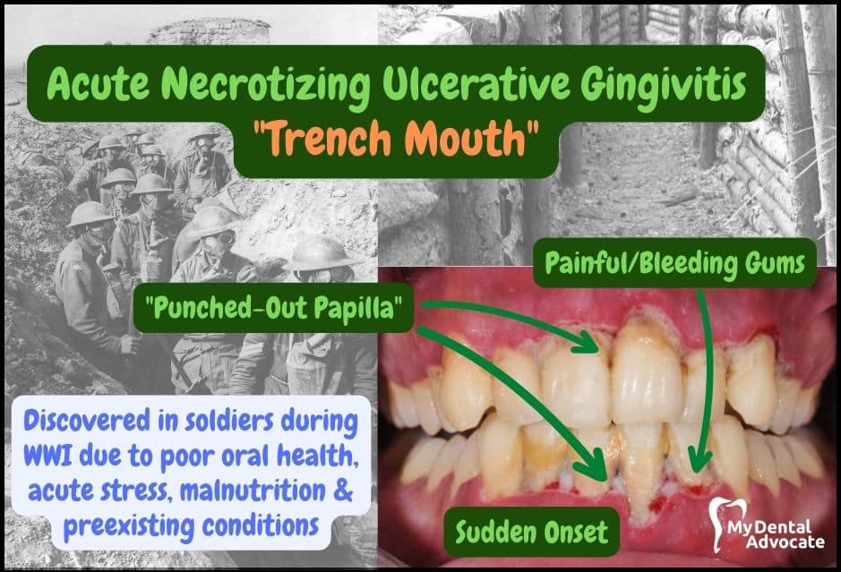 Acute Necrotizing Ulcerative Gingivitis 