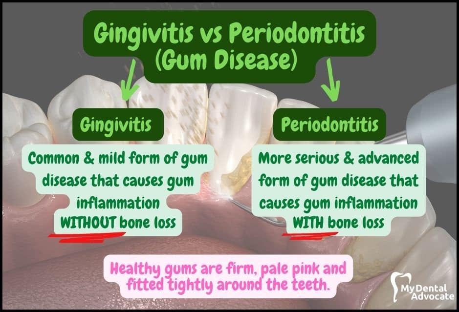 Gingivitis vs. Periodontitis | My Dental Advocate