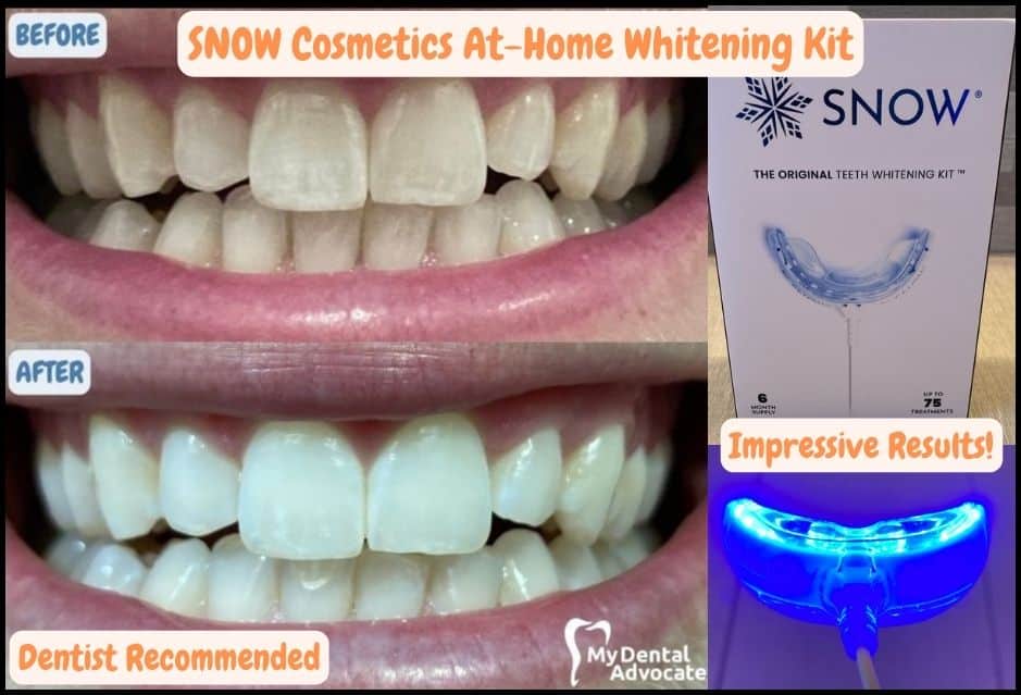 SNOW Teeth Whitening Before & After | My Dental Advocate