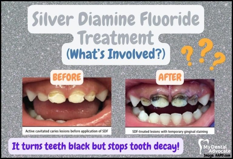 Silver Diamine Fluoride Treatment (What’s Involved?)