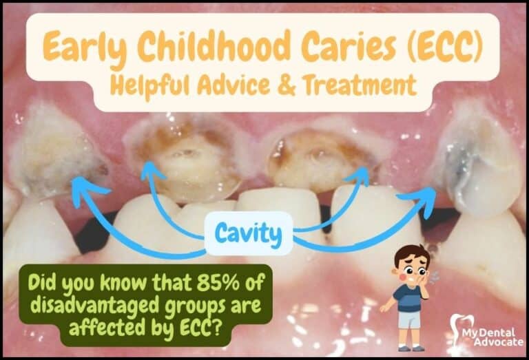 Early Childhood Caries | My Dental Advocate