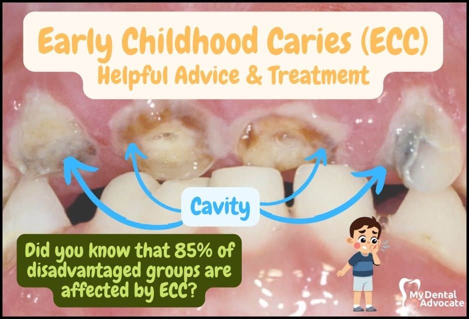 Early Dental Caries