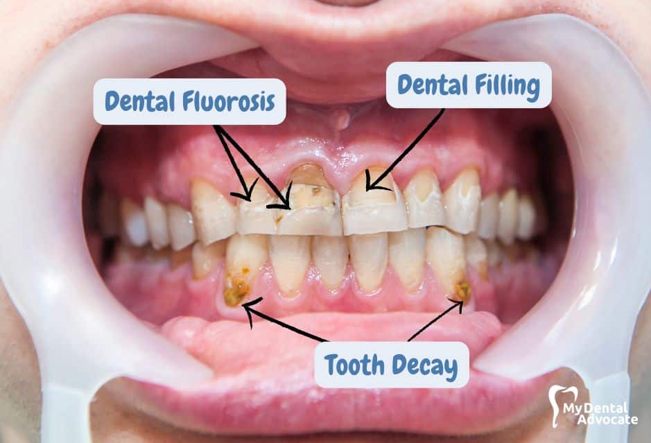 Dental Fluorosis in Patient | My Dental Advocate