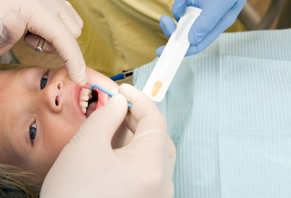 Child getting fluoride at the dentist | My Dental Advocate