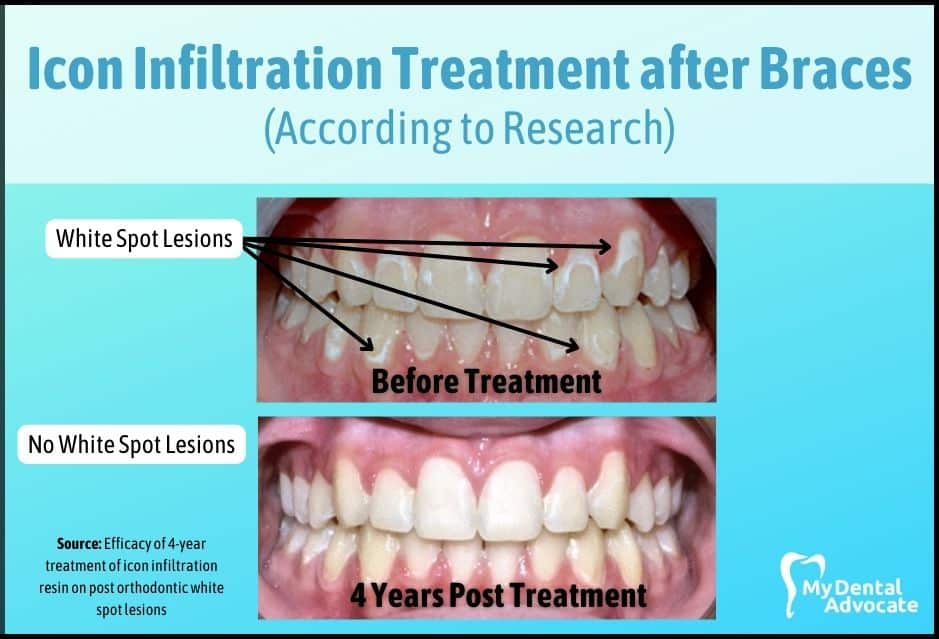 Icon Infiltration White Spot Lesions Braces | My Dental Advocate