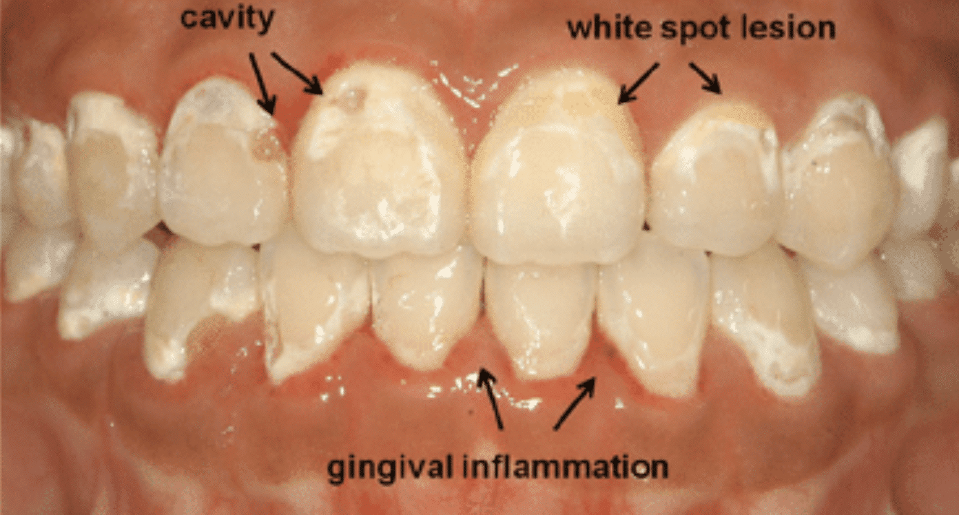 White Spot Lesions after Braces | My Dental Advocate