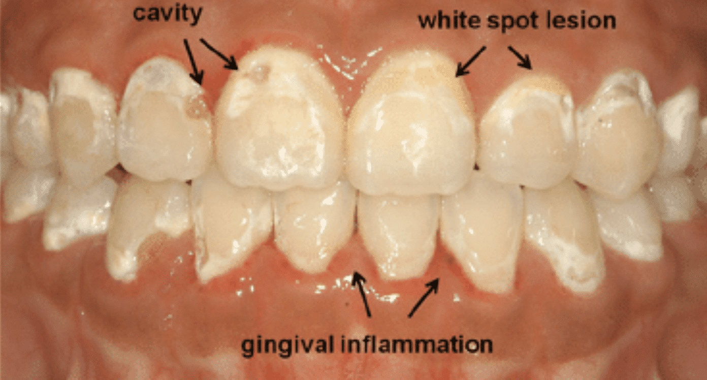 Braces Cause Teeth Stains? (How to Prevent Them)