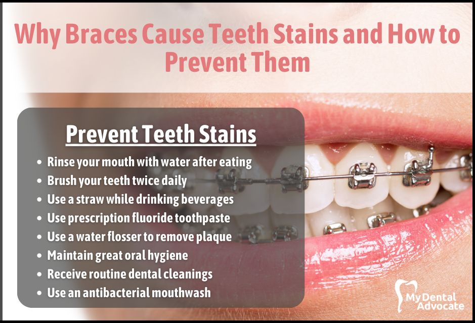 Why Braces Cause Teeth Stains and How to Prevent Them | My Dental Advocate