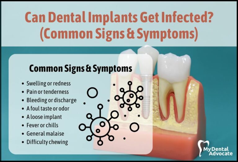 Can Dental Implants Get Infected? (Common Signs & Symptoms)