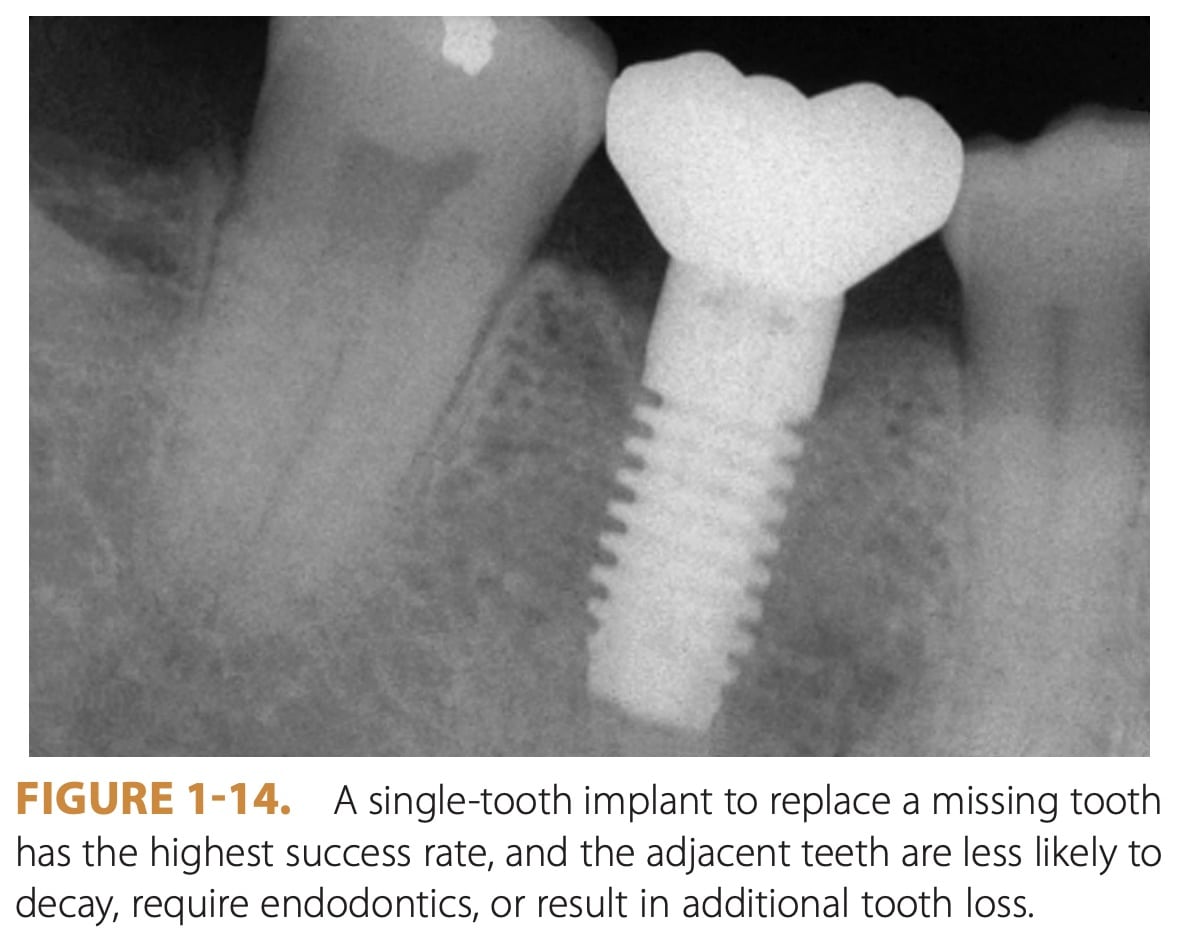 Single-Tooth Implant Radiograph X-ray | My Dental Advocate