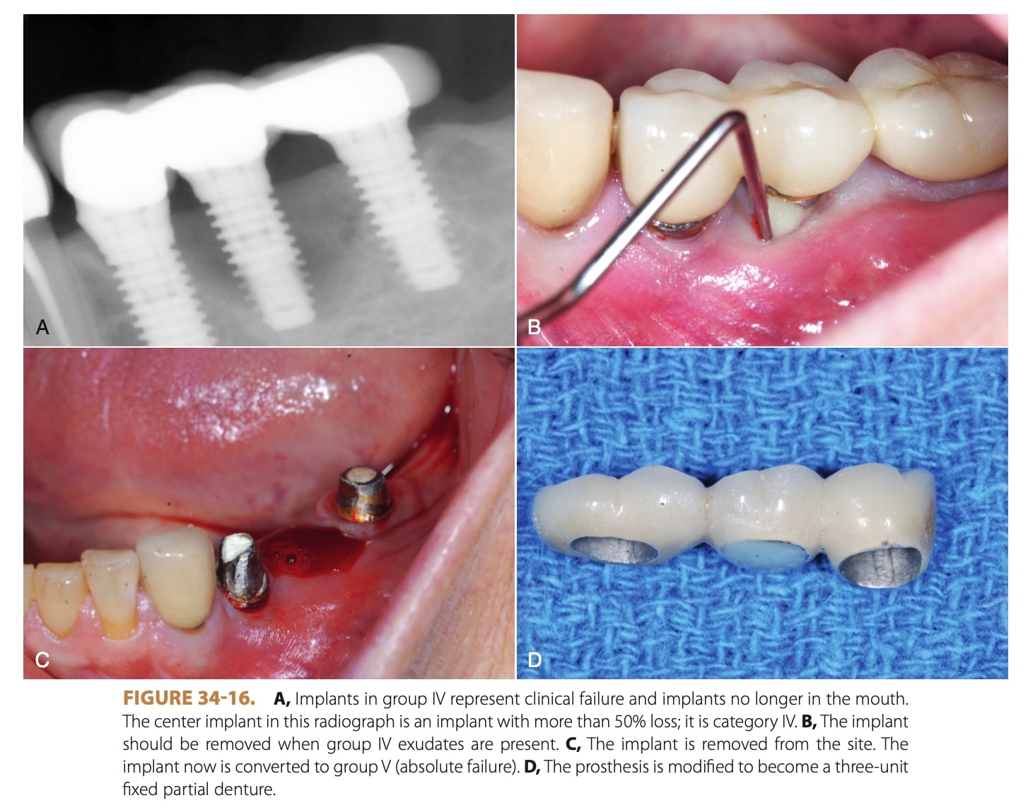 Dental Implant Infections | My Dental Advocate