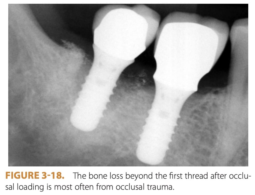 Throbbing Pain After Dental Implant Crown (Common Reasons) | My Dental Advocate