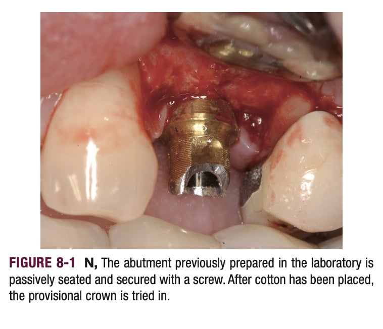Dental Implant Abutment Placement | My Dental Advocate