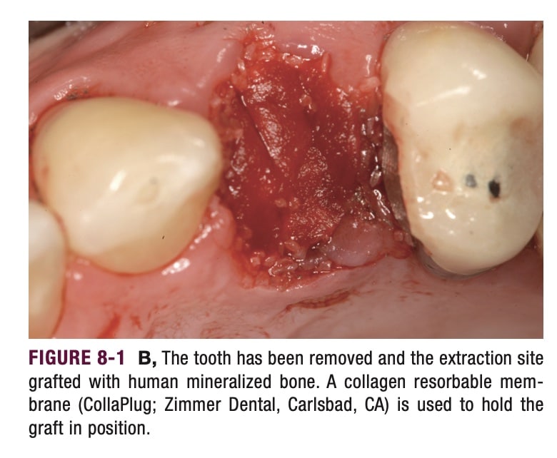 Dental Implant Bone Graft | My Dental Advocate