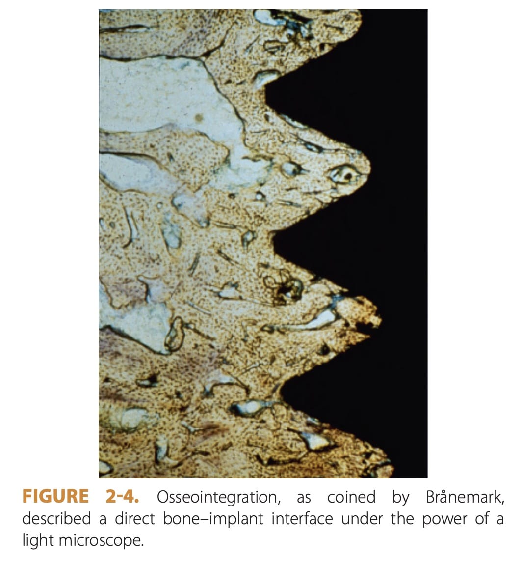 Osseointegration | Dental Implant Material Types (Comprehensive Overview) | My Dental Advocate