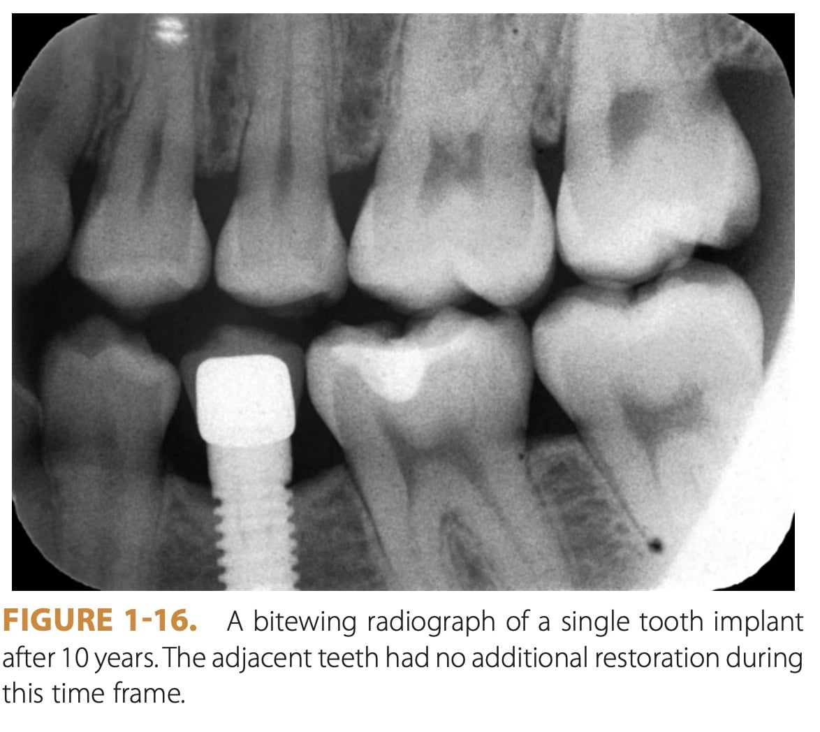 Dental Implant Material Types (Comprehensive Overview) | My Dental Advocate