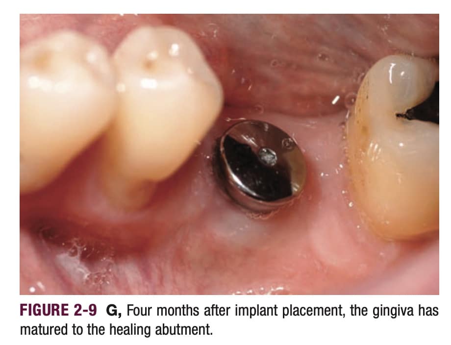 Tooth Extraction And Implant Timeline What To Expect Mda