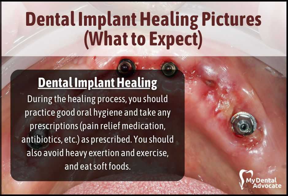 How to Implant Surgery Dental Recovery  