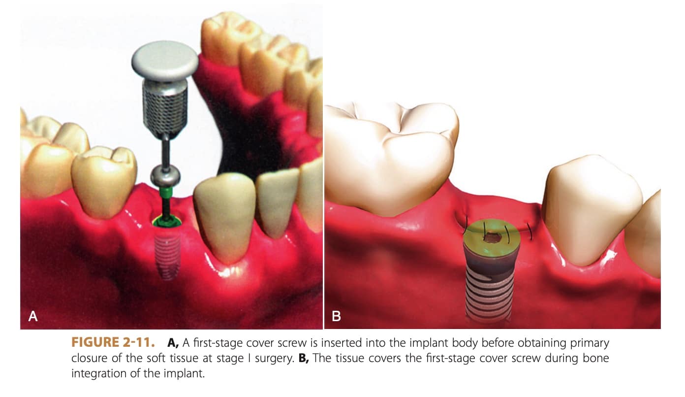 Understanding the Parts of a Dental Implant: A Comprehensive Guide | My Dental Advocate