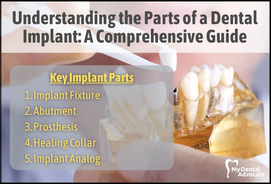 Understanding the Parts of a Dental Implant: A Comprehensive Guide | My Dental Advocate