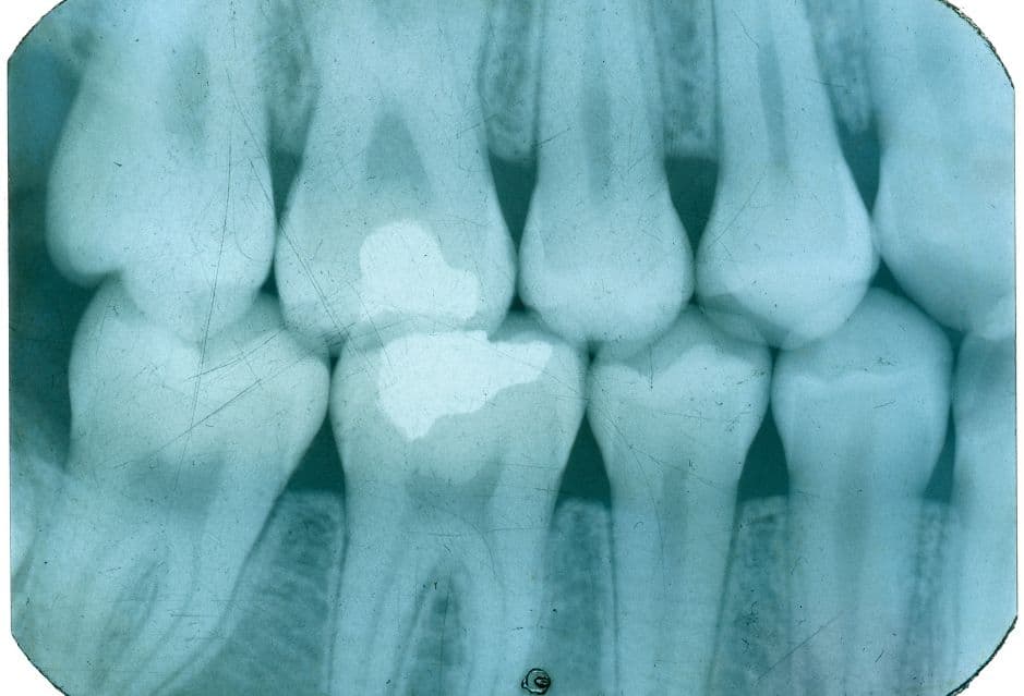 ☢️ FMX Dental X-ray Guide (Are They Safe?)